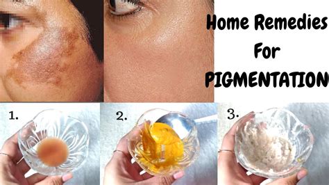Home Remedies To Get Rid Of Pigmentation In Just 10 Days | Top 3 Natural Ways To Cure ...