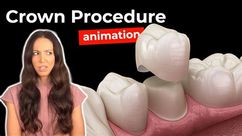 Dental Crown Procedure at the Dentist - YouTube