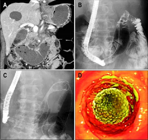 Stent placement procedure. (A) A computed tomography scan revealed a ...