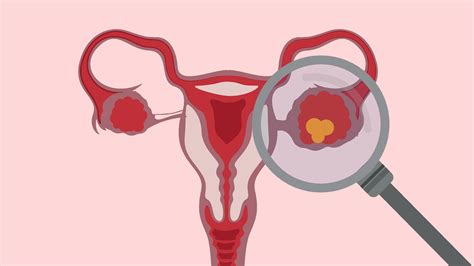 Ovarian Cysts Signs, Symptoms And Medical Advice | Glamour UK