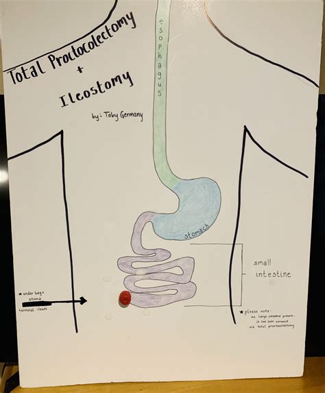 Total Proctocolectomy with Permanent Ileostomy – Human STEAM