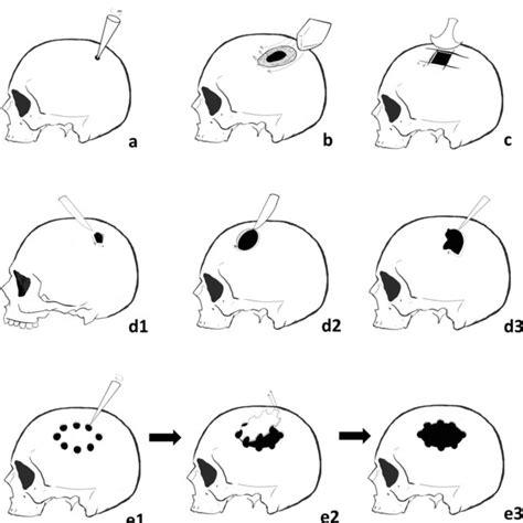 Trepanations in the M1 skull. The boring-and-cutting trepanation on the... | Download Scientific ...