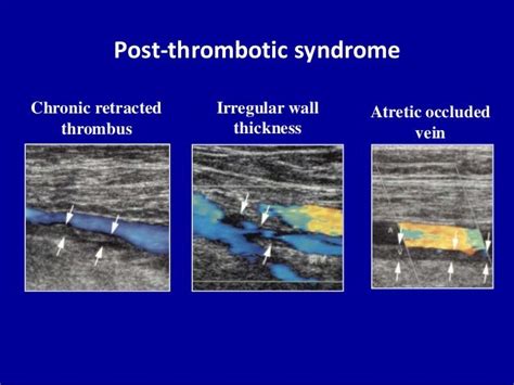 Doppler ultrasound in deep vein thrombosis