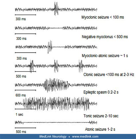 Myoclonic-atonic seizures | MedLink Neurology