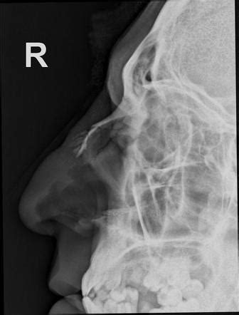 Nasal Fracture X Ray