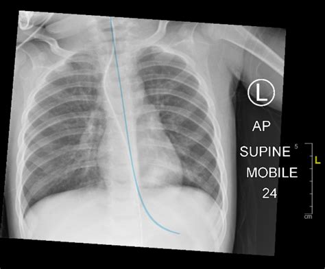 An infant with a persistent cough and an unusual course of the nasogastric tube | Archives of ...