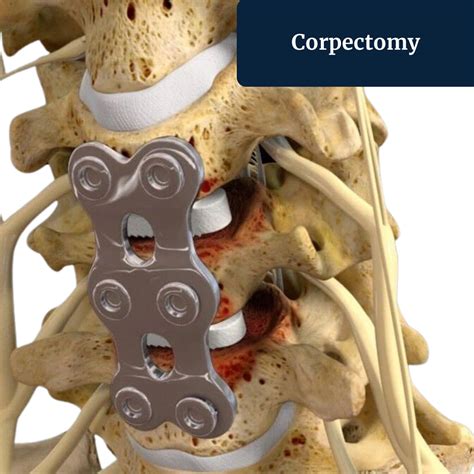 Cervical Corpectomy Surgery Irving, TX | Corpectomy Procedure in Dallas, TX