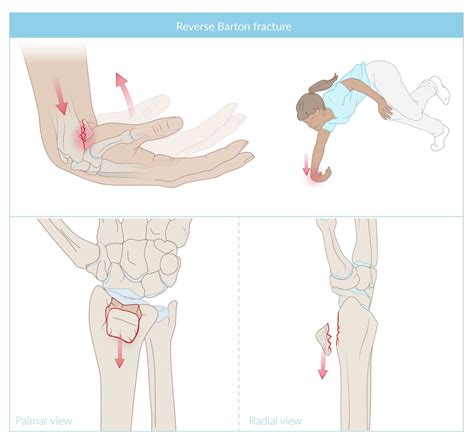 Reverse Colles Fracture