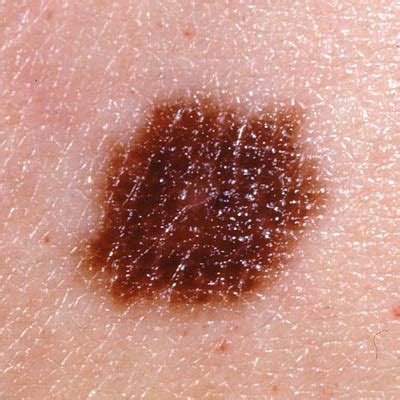 Dysplastic nevus - What Skin Cancer Looks Like - Health.com