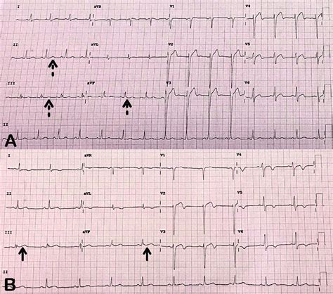 (A) Electrocardiography showing ST-segment elevation in leads V1-V6... | Download Scientific Diagram