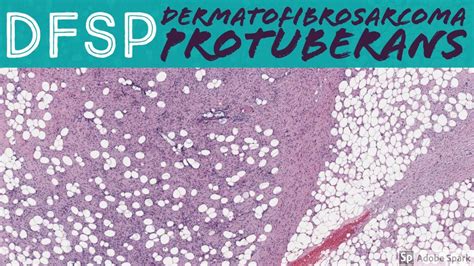 Dermatofibrosarcoma Protuberans Histology