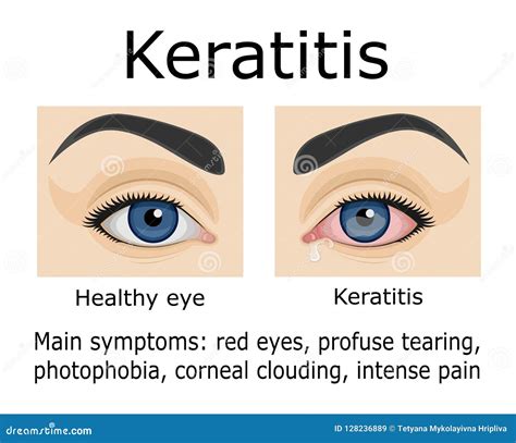 Keratitis Cartoons, Illustrations & Vector Stock Images - 129 Pictures to download from ...