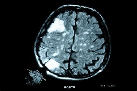 Dementia From Brain Conditions