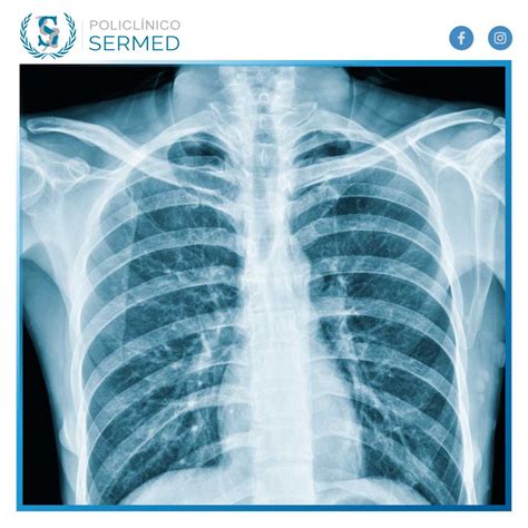 Rayos X de Tórax ¿Qué es, cómo funciona y las precauciones qu...