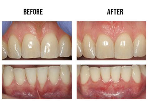 Smile Bright Periodontics - Frenectomy