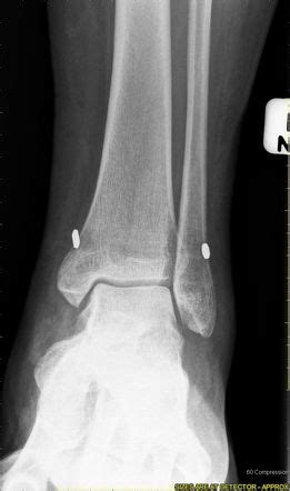 TightRope fixation - left ankle | Image | Radiopaedia.org