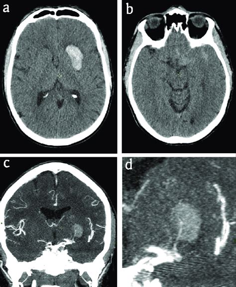 CT. (a) Plain CT: Hemorrhage in the left basal ganglia (Arrow) (b)... | Download Scientific Diagram