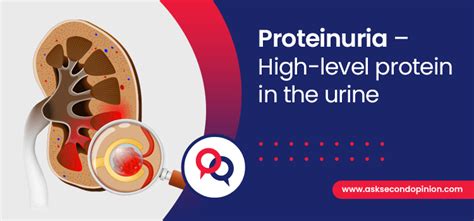 Proteinuria - High-level protein in the urine - Second Opinion