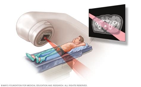 External beam radiation for prostate cancer - Mayo Clinic