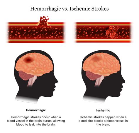 Which of the Following Is Accurate Regarding a Hemorrhagic Stroke ...