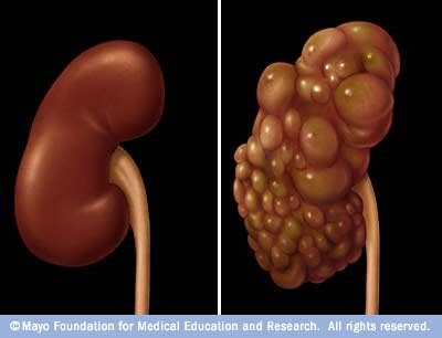 Health Perfect: Kidney Cysts – Information on Kidney Cysts