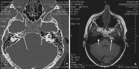 Cyst Of Petrous