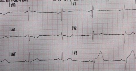 Dr. Smith's ECG Blog: 10 Cases of Inferior Hyperacute T-waves