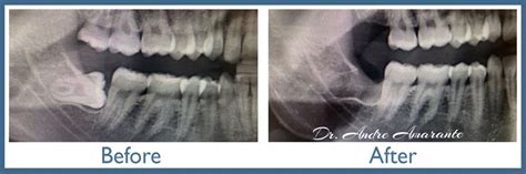 Wisdom Tooth Extraction | High Quality Oral Surgeon in Evanston IL ...