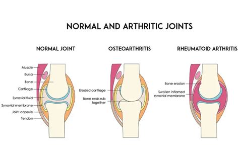 Arthritis (Joint Inflammation) - Causes and Symptoms | Parkway East ...