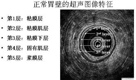 什么是超声胃镜-什么是超声胃镜