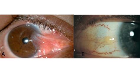 Pinguecula And Pterygium: All You Need To Know | Eyemantra Hospital