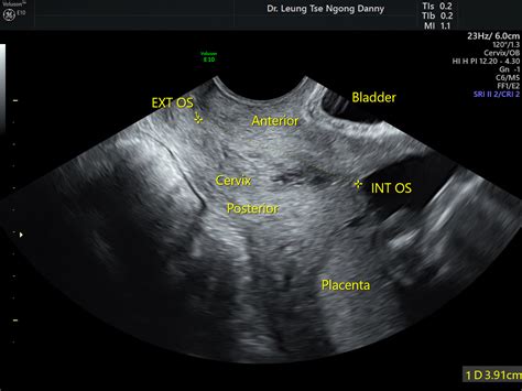 Cervical incompetence - HKOG-INFO