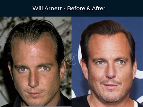 56 Celebrity Hair Transplants | Before & After Photos (2023)