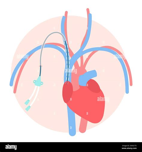 Central Venous Catheter Purpose