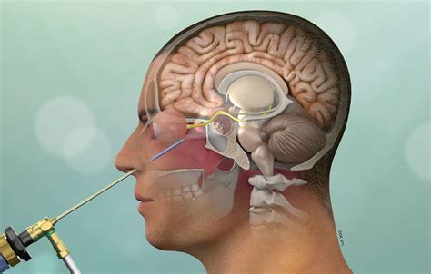 Cushing’s disease is caused by a tumor of the pituitary gland and often ...