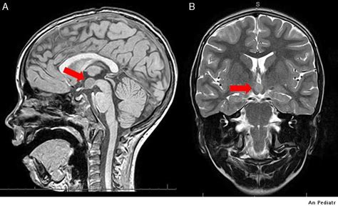 Forms of clinical presentation of hypothalamic hamartoma | Anales de ...