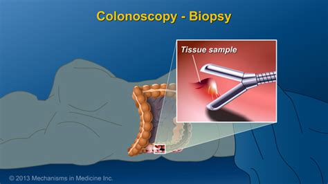 Slide Show - Diagnosing IBD