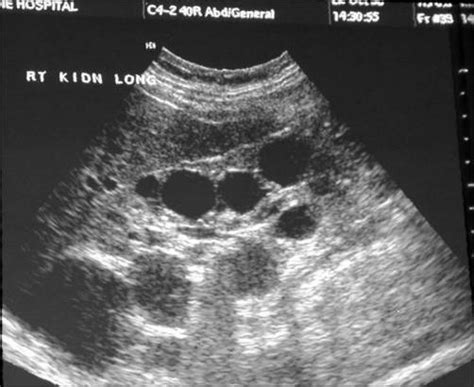 Easy Nephrology: How to diagnose Autosomal Dominant Polycystic Kidney Disease (ADPKD)