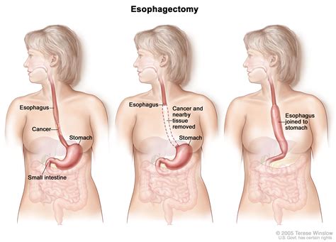 Esophageal Cancer Treatment - NCI