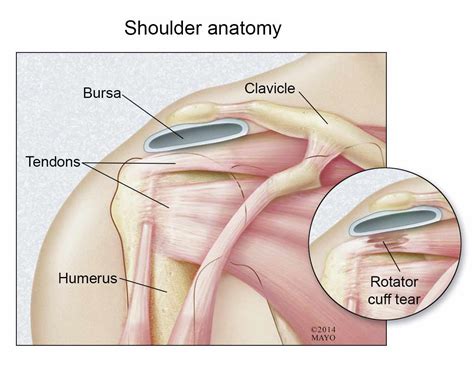 Tuesday Q and A: Reverse shoulder arthroplasty may be best option for patient with torn rotator ...