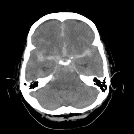 Case Report: Cerebral Aneurysm Rerupture Practical, 44% OFF