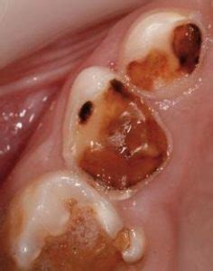 Arrested Caries – Causes, Color, Stages of Development and Treatment