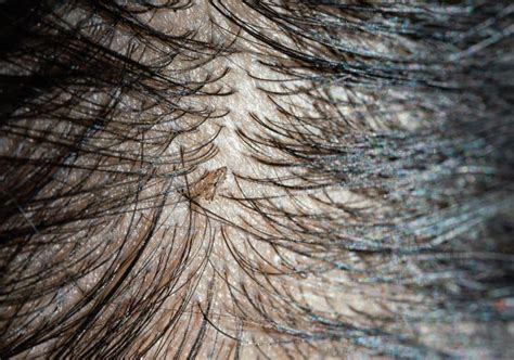 Louse Egg on the Hair Causes Itchy Head Stock Photo - Image of care ...