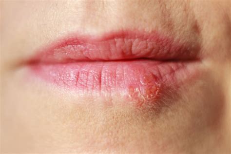 Mouth ulcers and cold sores: What’s the difference?