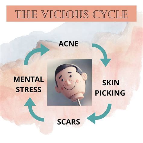 Acne Excoriee: Treatment and Causes