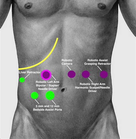 Port location for abdominal portion. The yellow line denotes the costal... | Download Scientific ...