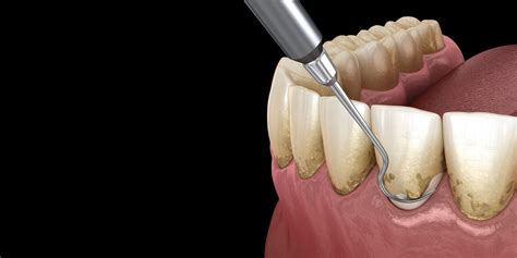 Scaling and Root Planing | Arkansas Periodontal and Implant Associates