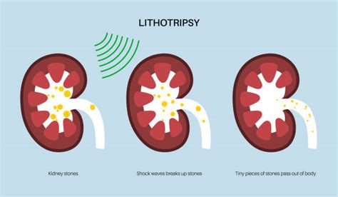 70+ Laser Lithotripsy Stock Photos, Pictures & Royalty-Free Images - iStock