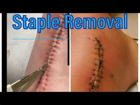 Staple Removal after surgery and your common questions answered! | Broken Ankle 101 Series - YouTube