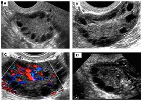 Normal Vs Polycystic Ovaries Ultrasound